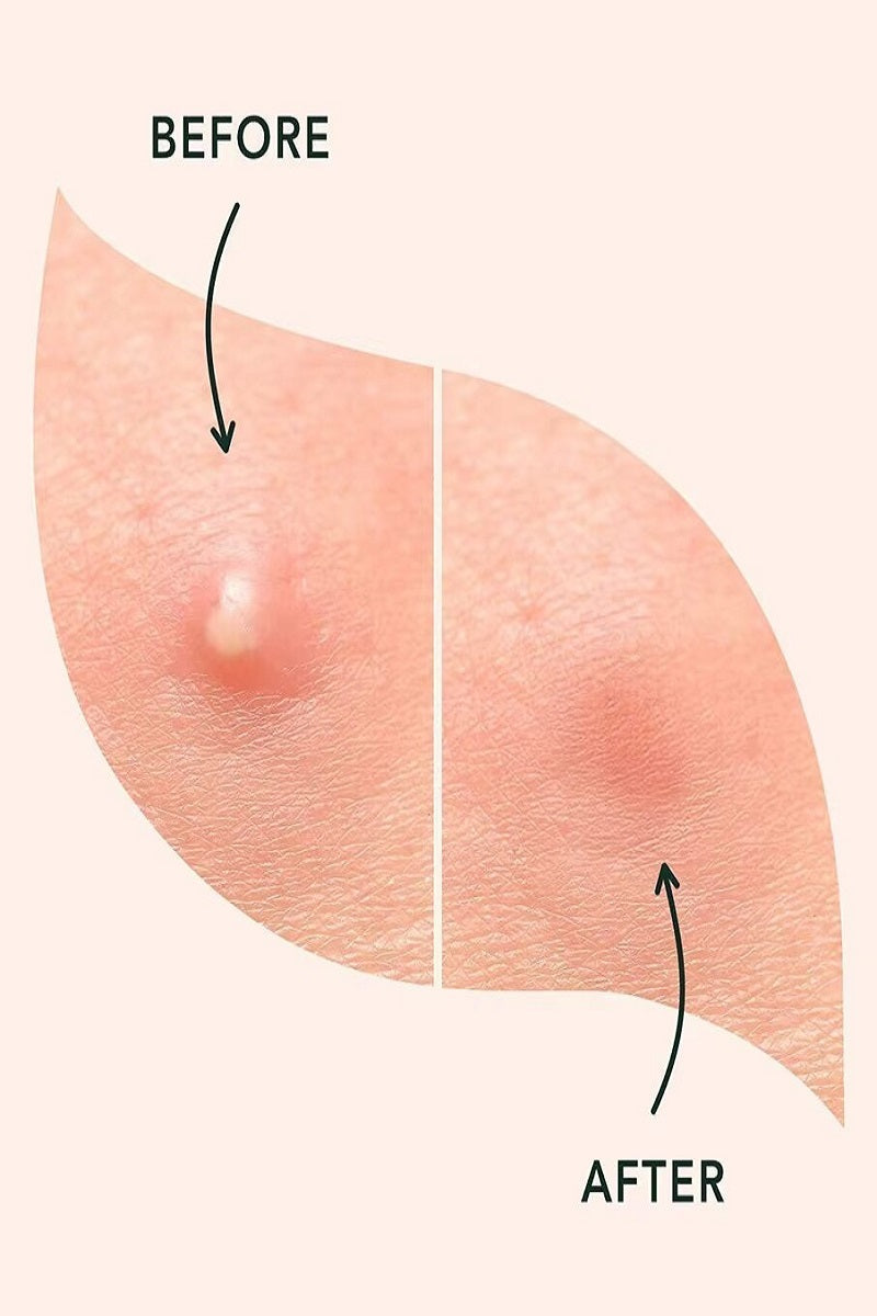 The original hydrocolloid acne pimple patch