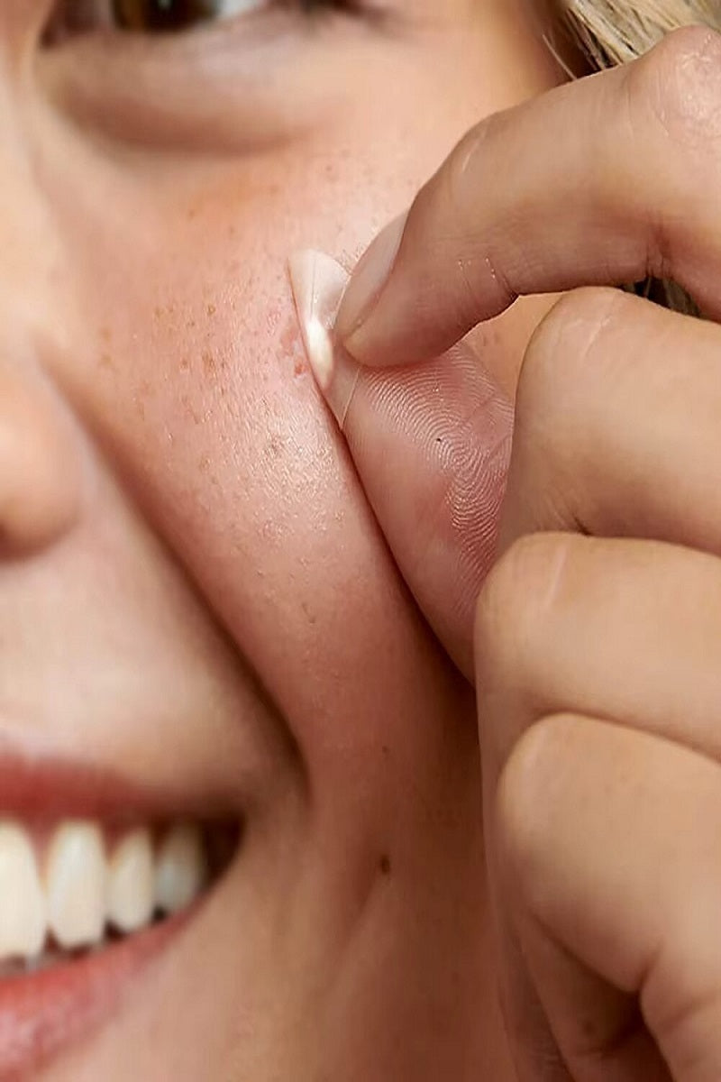 The original hydrocolloid acne pimple patch