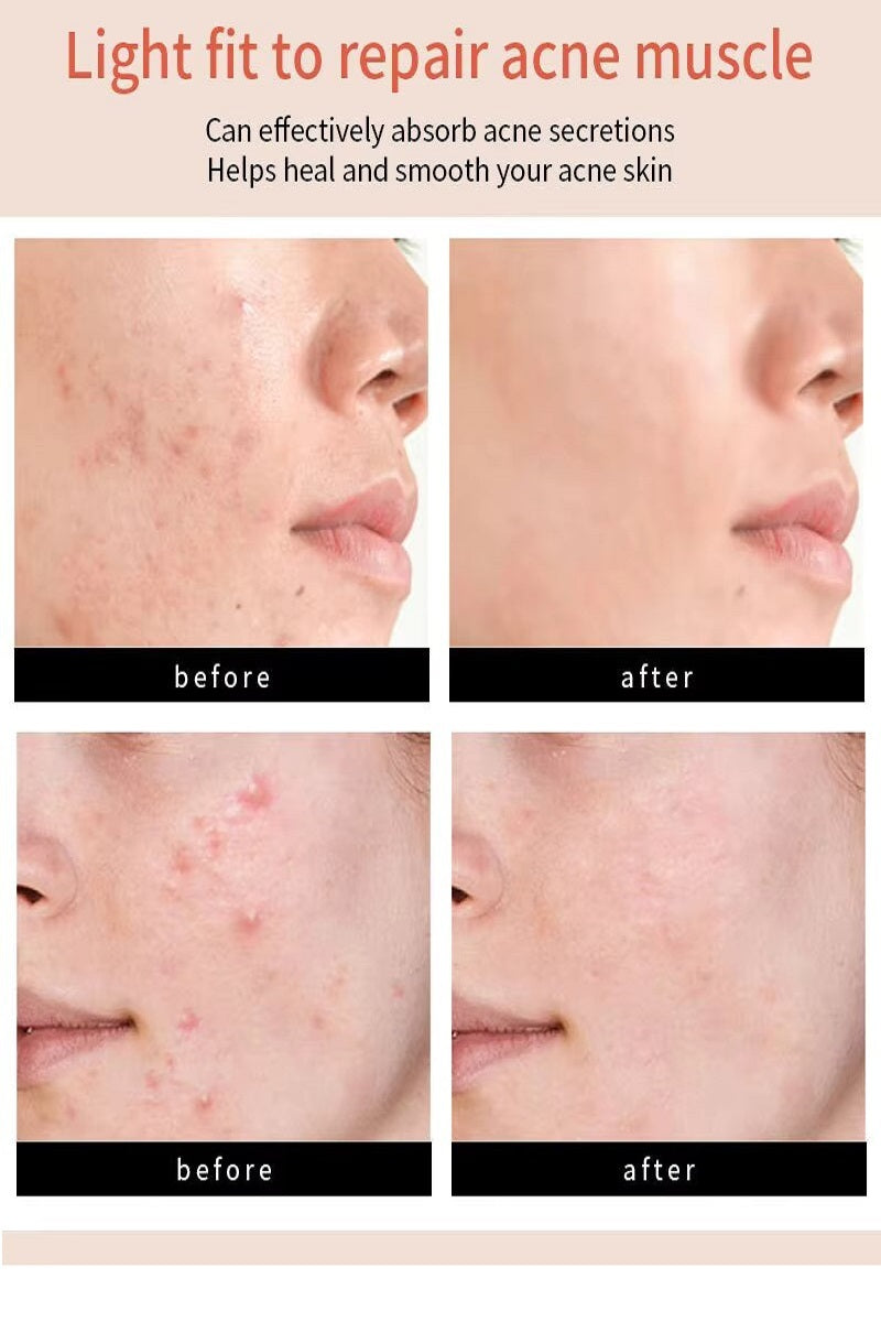 The original hydrocolloid acne pimple patch